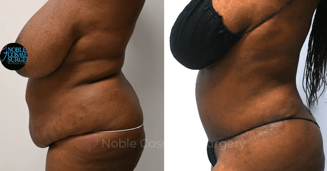 TUMMY-TUCK-CASE-11720 | Before and After Abdominoplasty 4