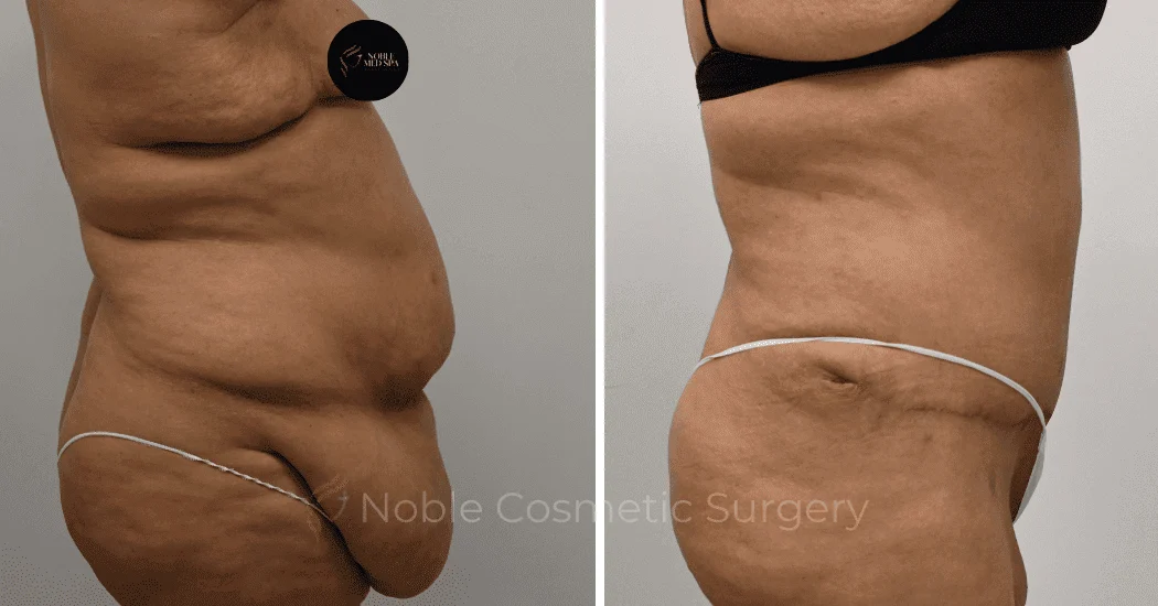 TUMMY-TUCK-CASE-12513 | Before and After Abdominoplasty 3