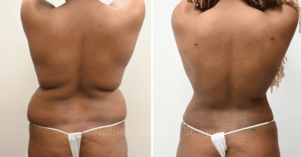 LIPOSUCTION-CASE-13859 | Before and After Liposuction 1