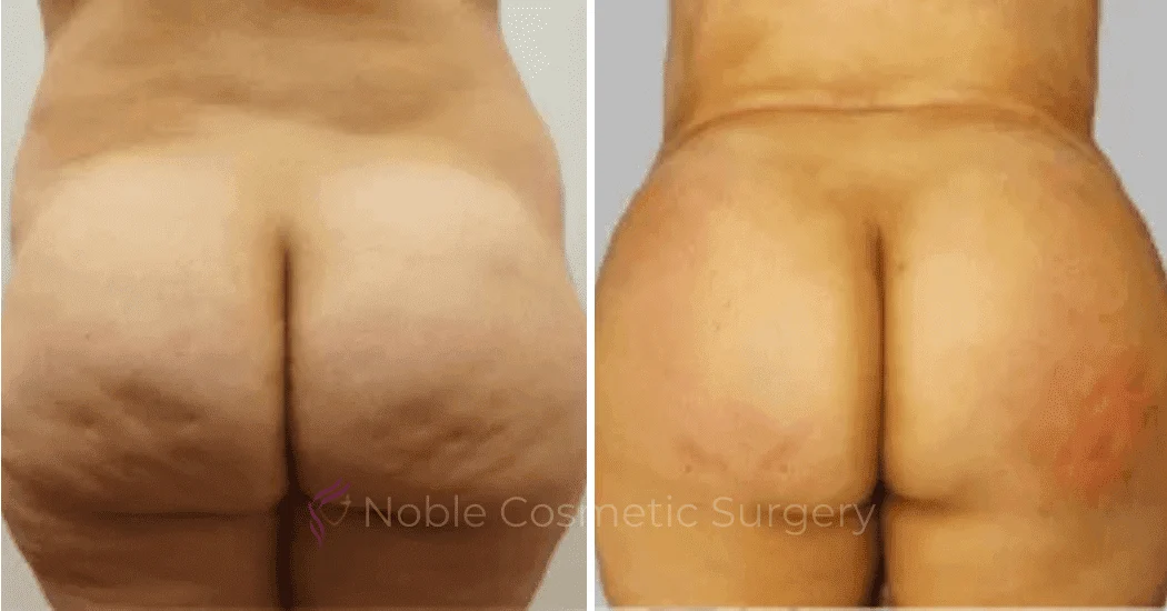 Brazilian-Butt-Lift-Case-15106 | Before and After Brazilian Butt Lift 1