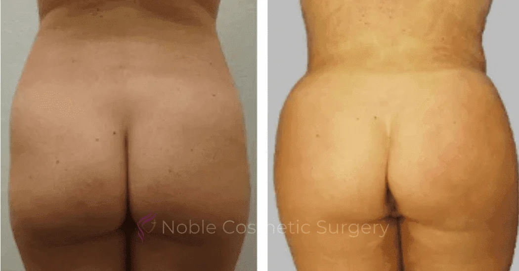 Brazilian-Butt-Lift-Case-15107 | Before and After Brazilian Butt Lift 1