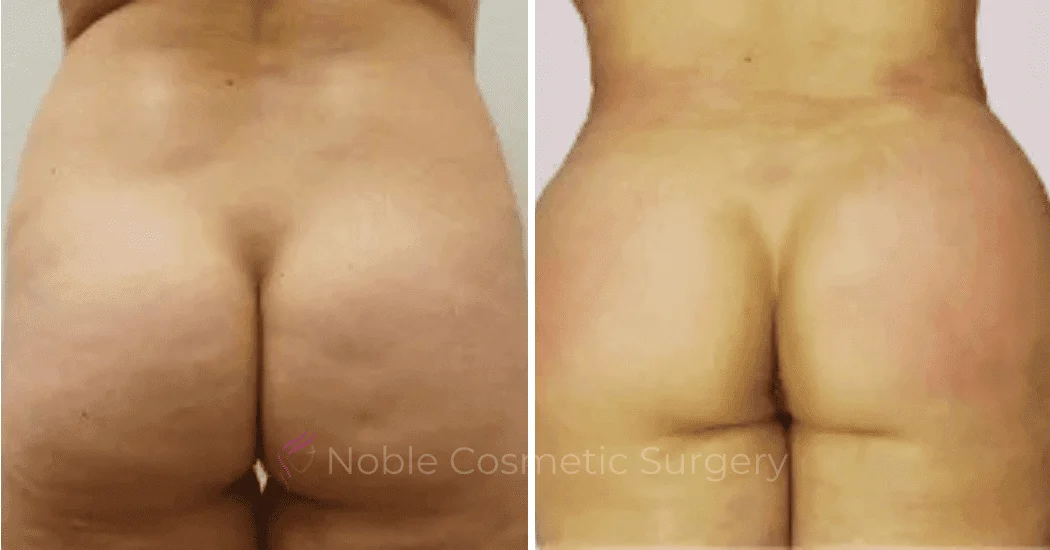 Brazilian-Butt-Lift-Case-15108 | Before and After Brazilian Butt Lift 1