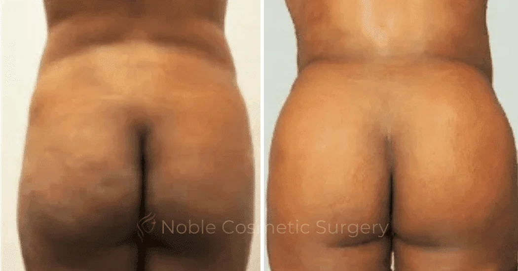 Brazilian-Butt-Lift-Case-15109 | Before and After Brazilian Butt Lift 1