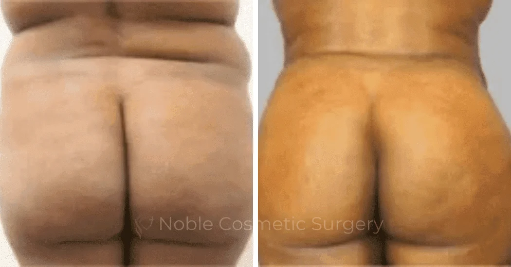 Brazilian-Butt-Lift-Case-15110 | Before and After Brazilian Butt Lift 1