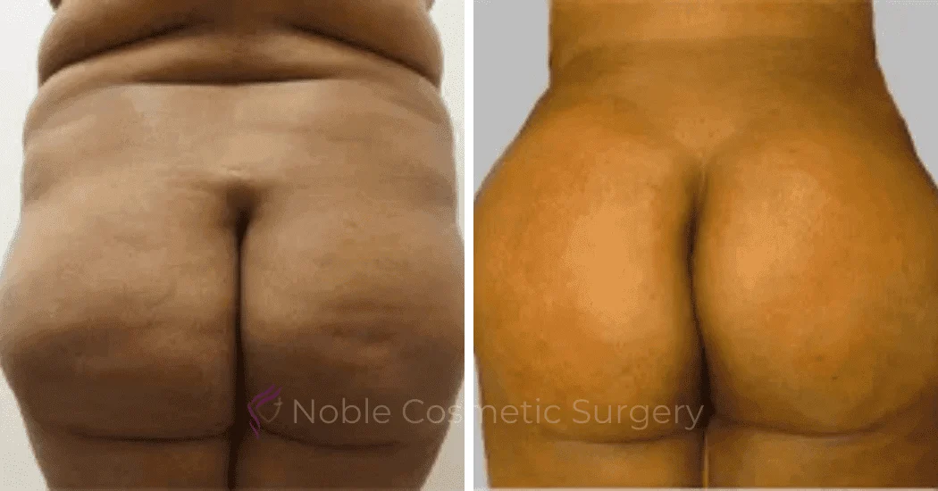 Brazilian-Butt-Lift-Case-15111 | Before and After Brazilian Butt Lift 1