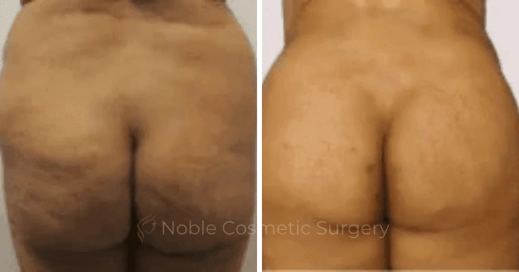 Brazilian-Butt-Lift-Case-15112 | Before and After Brazilian Butt Lift 1