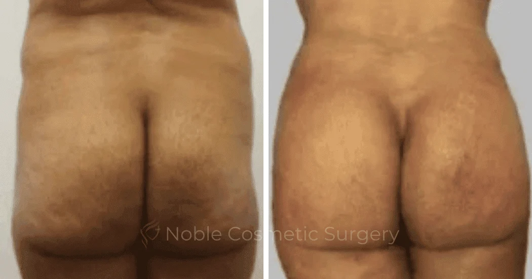 Brazilian-Butt-Lift-Case-15113 | Before and After Brazilian Butt Lift 1
