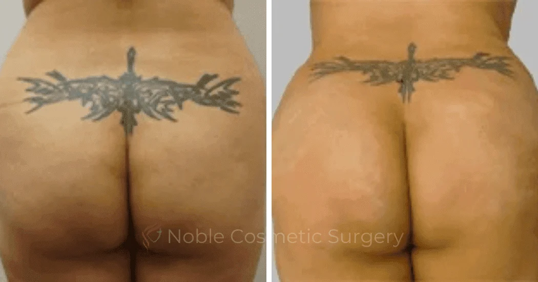 Brazilian-Butt-Lift-Case-15116 | Before and After Brazilian Butt Lift 1
