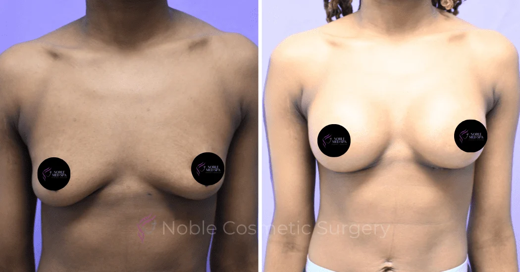 BREAST-AUGMENTATION--CASE-19521 | Before and After Breast Augmentation 1