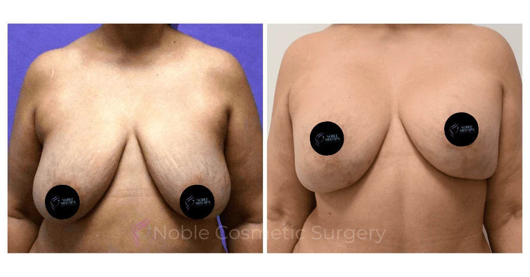BREAST-REDUCTION-CASE-00220 | Before and After Breast Reduction 1