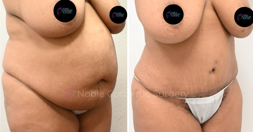 TUMMY-TUCK-CASE-00035 | Before and After Abdominoplasty 2
