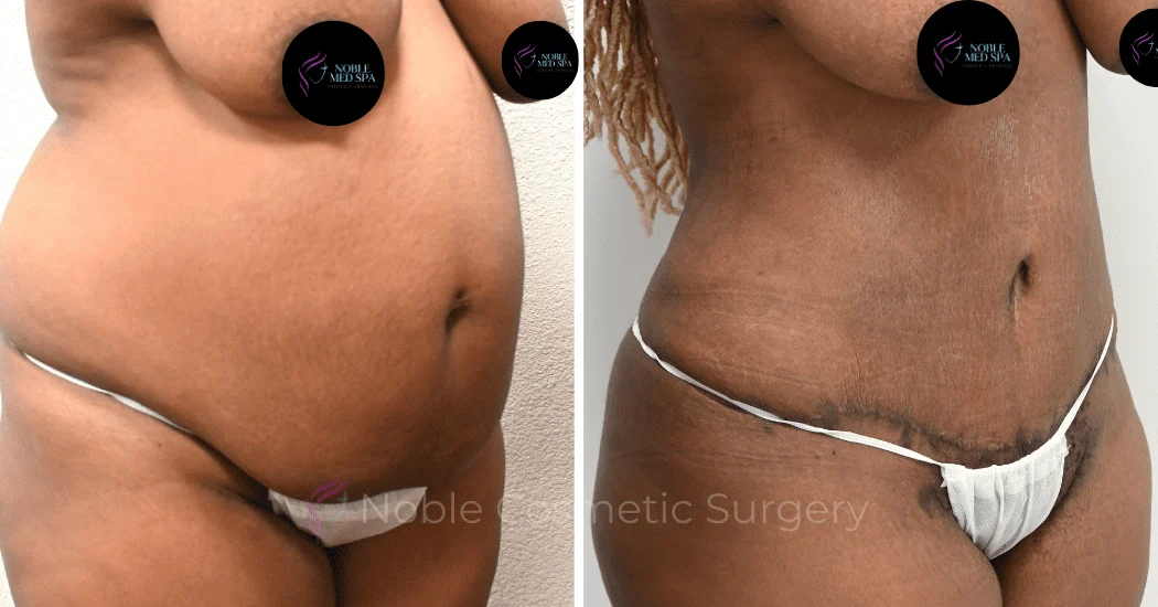 TUMMY-TUCK-CASE-13859 | Before and After Abdominoplasty 2