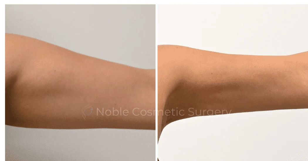 LIPOSUCTION-ARMS-CASE-00316 | Before and After Arm Liposuction 1