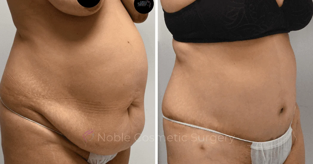 TUMMY-TUCK-CASE-11285 | Before and After Abdominoplasty 2