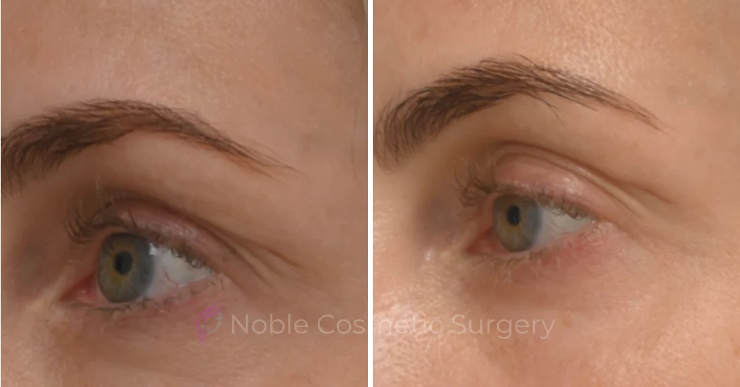 BLEPHAROPLASTY-CASE-10182 | Before and After Blepharoplasty 2