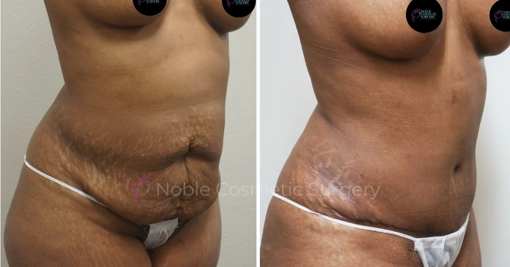 TUMMY-TUCK-CASE-00041 | Before and After Abdominoplasty 2