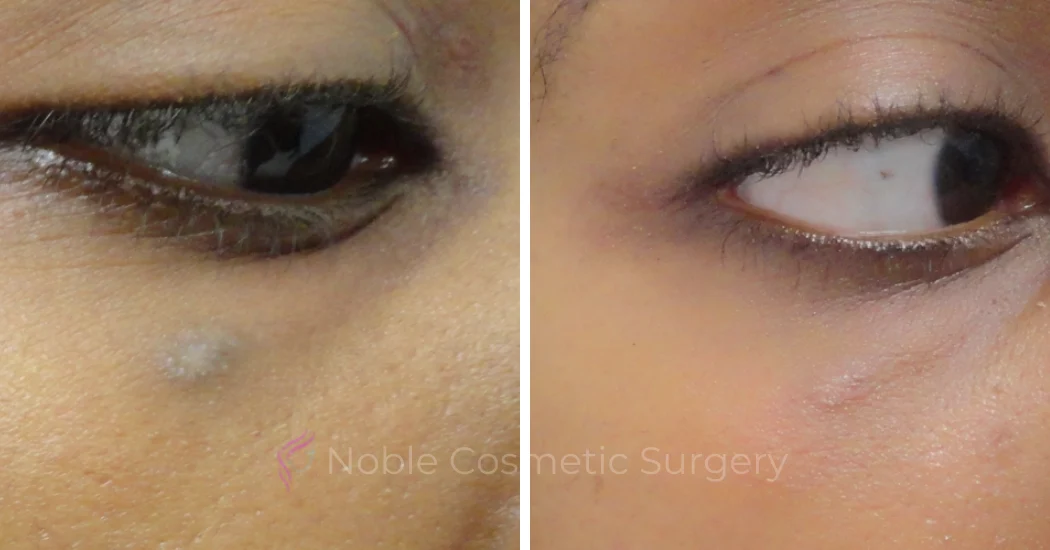 PICO-LASER-CASE-00001 | Before and After Pico Skin Rejuvenation 1