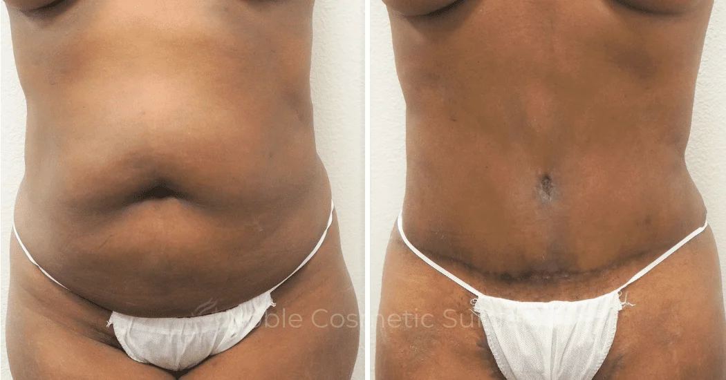 TUMMY-TUCK-CASE-00305 | Before and After Abdominoplasty 1