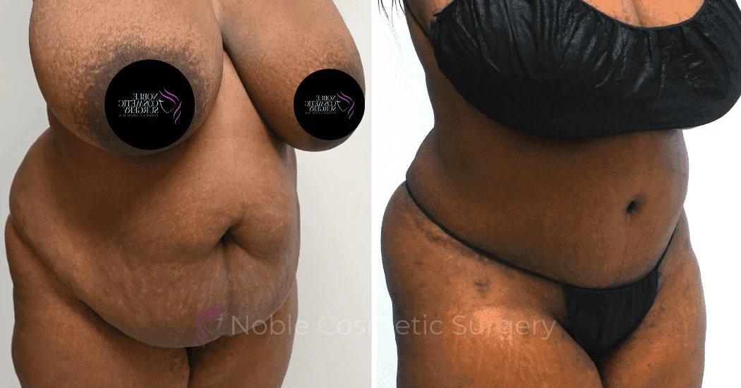 TUMMY-TUCK-CASE-11720 | Before and After Abdominoplasty 2