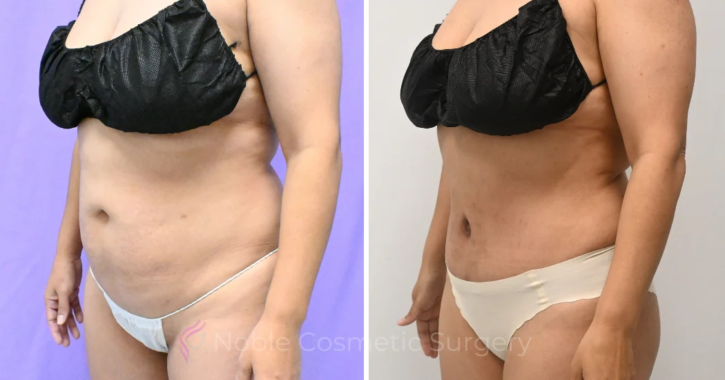 Case--20157 | Before and After Abdominoplasty 2