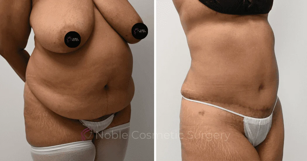 TUMMY-TUCK-CASE-11110 | Before and After Abdominoplasty 2