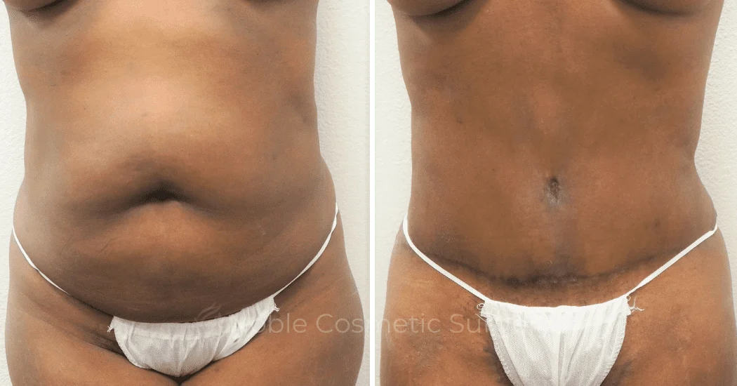 MOMMY-MAKEOVER-CASE-00305 | Before and After Mommy Makeover 1