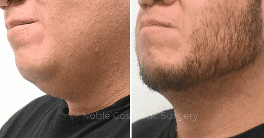 SUBMENTAL-LIPOSUCTION-CASE-19137 | Before and After Chin Liposuction 1