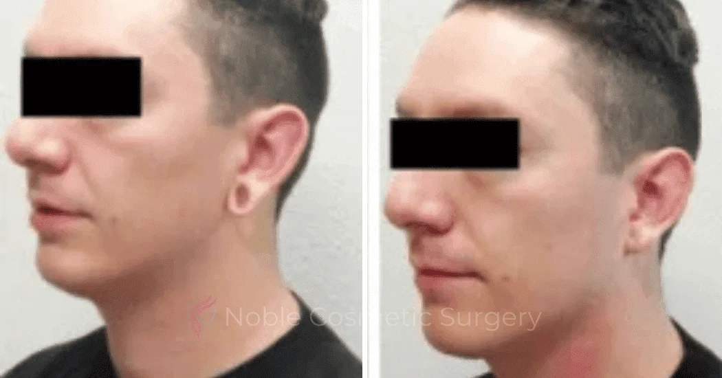 Earlobe-Repair-Case-20254 | Before and After Earlobe Repair 1
