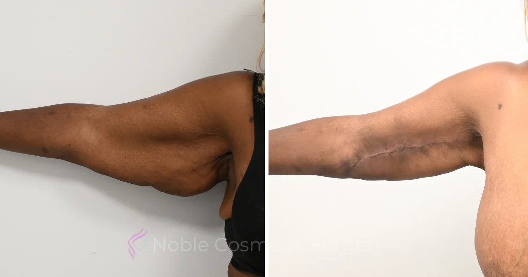 Case--20391 | Before and After Brachioplasty 1