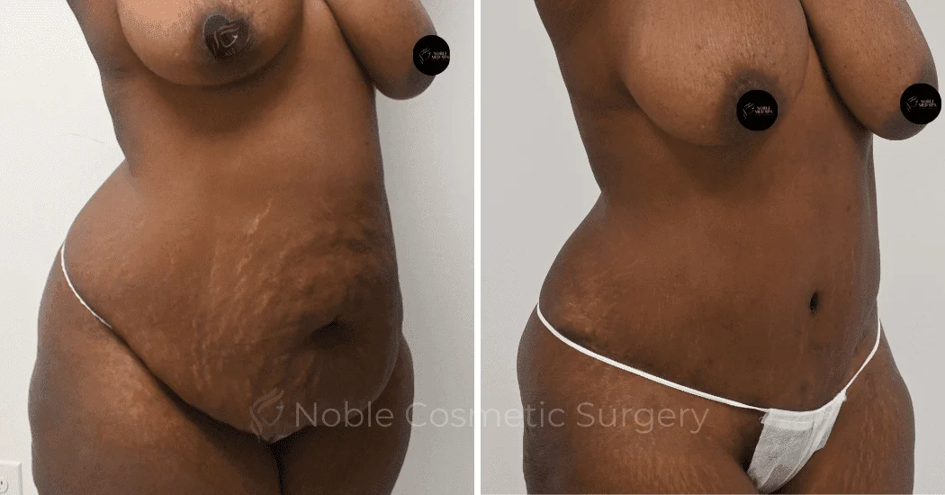 TUMMY-TUCK-CASE-10563 | Before and After Abdominoplasty 2