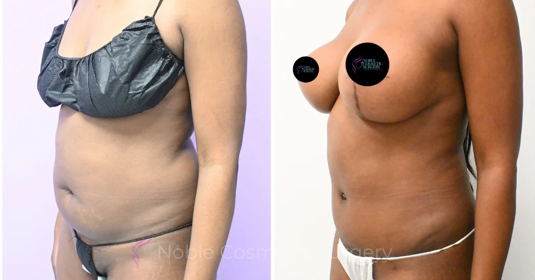 Case--20347 | Before and After Abdominoplasty 2