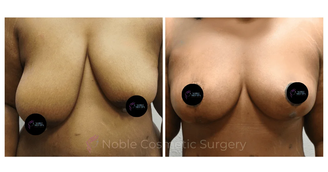 BREAST-REDUCTION-CASE-00801 | Before and After Breast Reduction 1