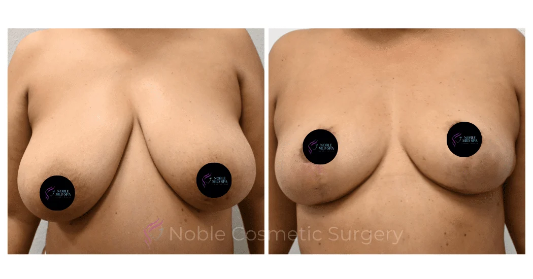 BREAST-REDUCTION-CASE-00802 | Before and After Breast Reduction 1