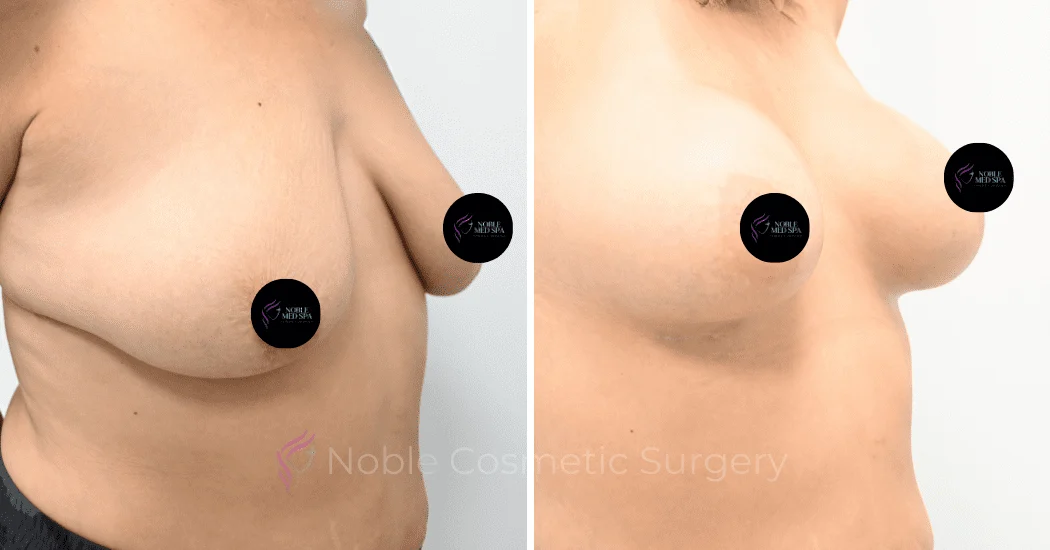 BREAST-AUGMENTATION-CASE-12478 | Before and After Breast Augmentation 1
