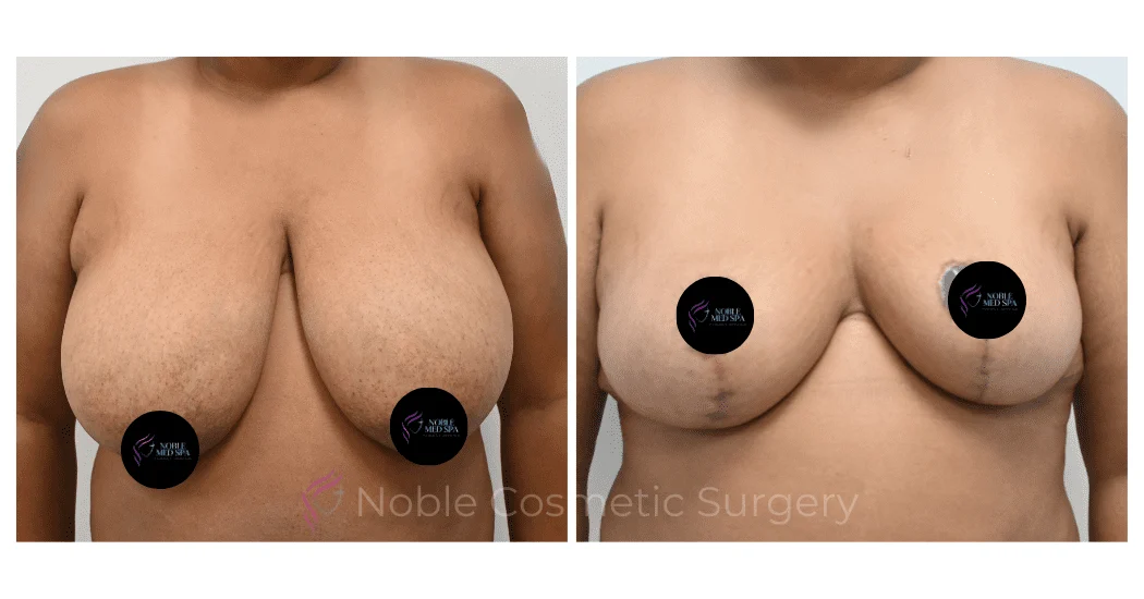 BREAST-REDUCTION-CASE-00803 | Before and After Breast Reduction 1