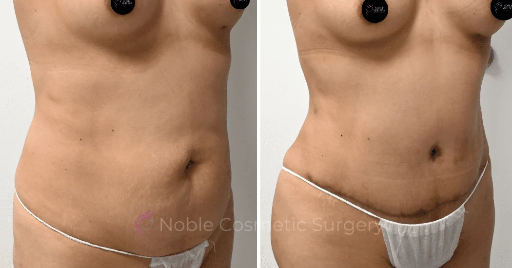 TUMMY-TUCK-CASE-00313 | Before and After Abdominoplasty 2