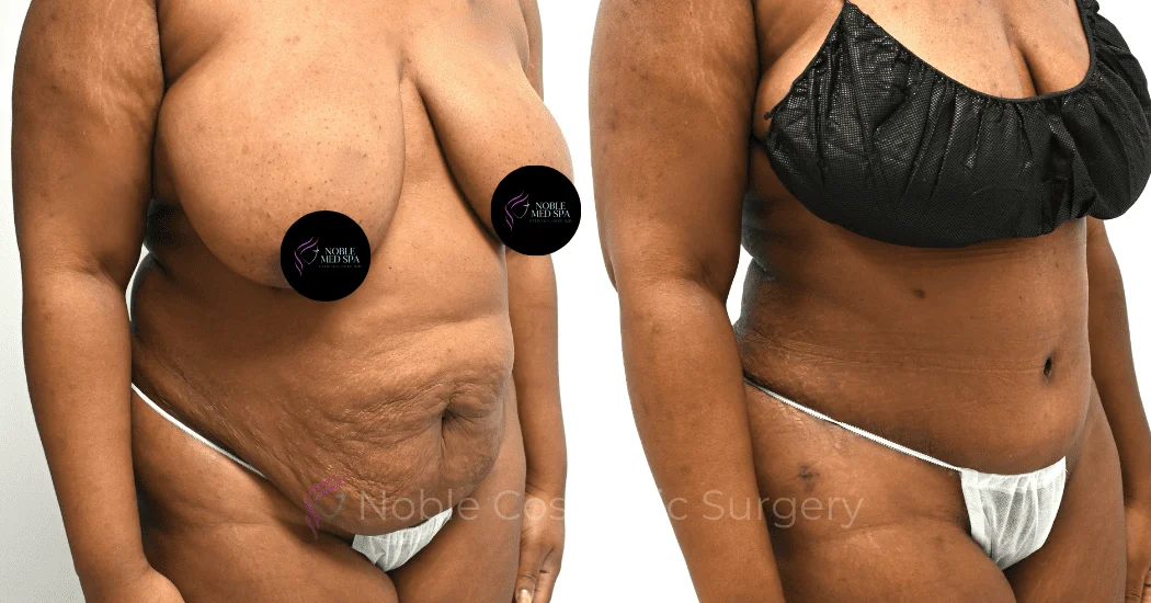 TUMMY-TUCK-CASE-00308 | Before and After Abdominoplasty 2