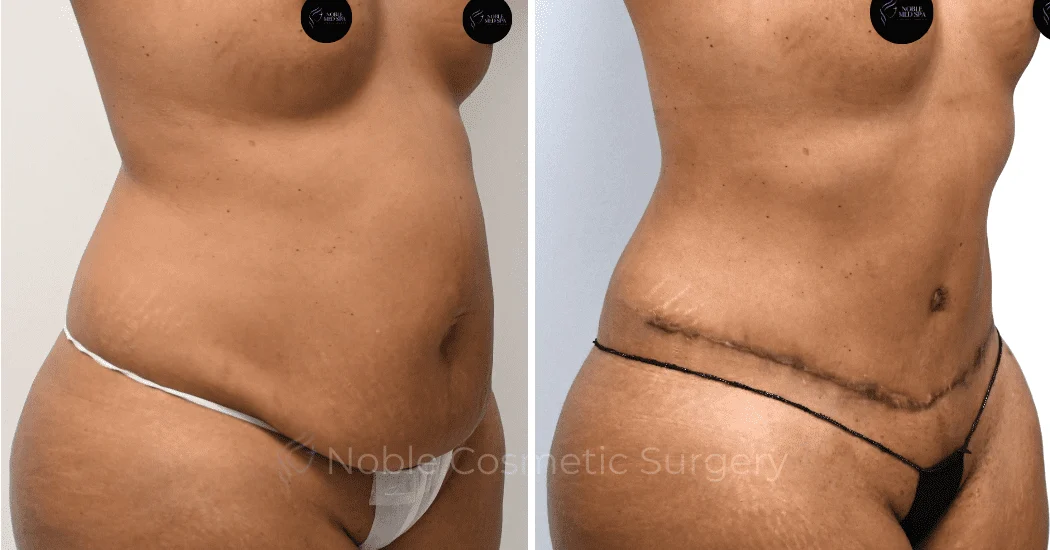 TUMMY-TUCK-CASE-00312 | Before and After Abdominoplasty 2