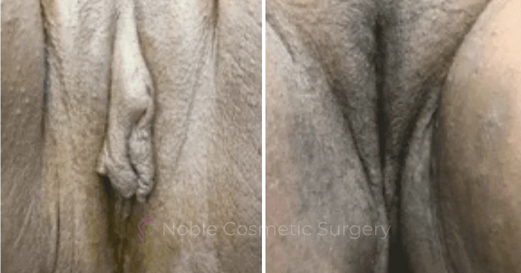 Labiaplasty-Case-20266 | Before and After Labiaplasty 1