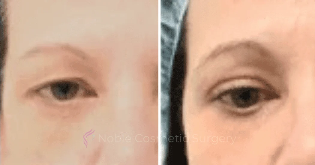 BLEPHAROPLASTY-CASE-20259 | Before and After Blepharoplasty 1