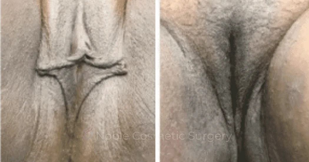 Labiaplasty-Case-20265 | Before and After Labiaplasty 1