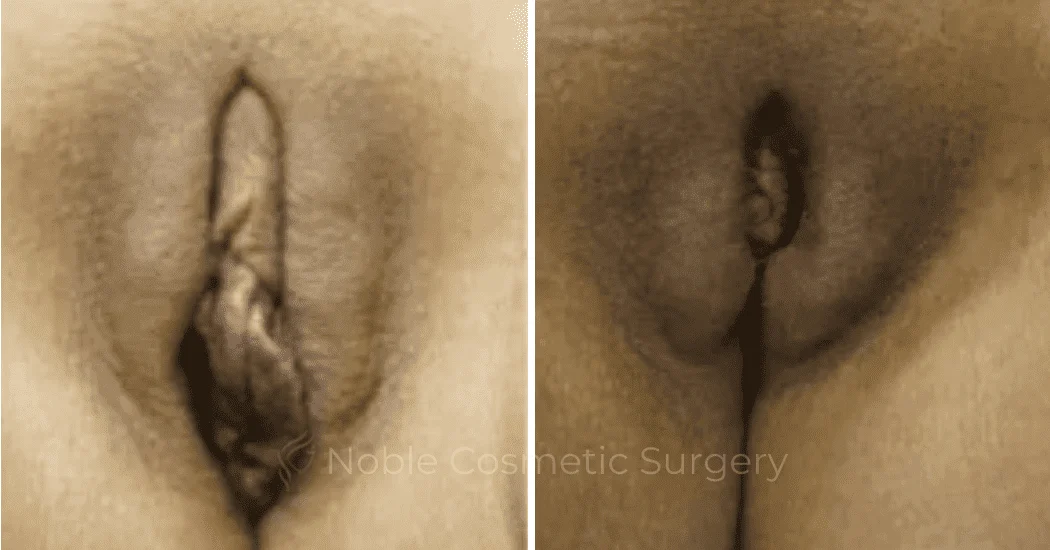 Labiaplasty-Case-20264 | Before and After Labiaplasty 1