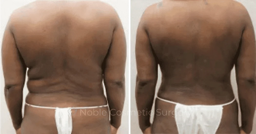 Back-Lift-Case-00254 | Before and After Back Lift 1