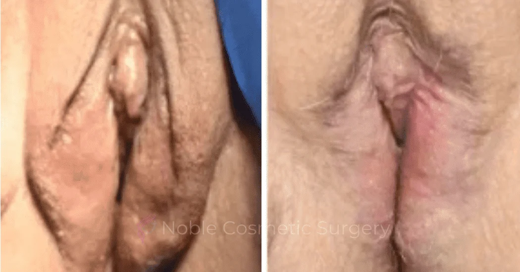 Labiaplasty-Case-20263 | Before and After Labiaplasty 1
