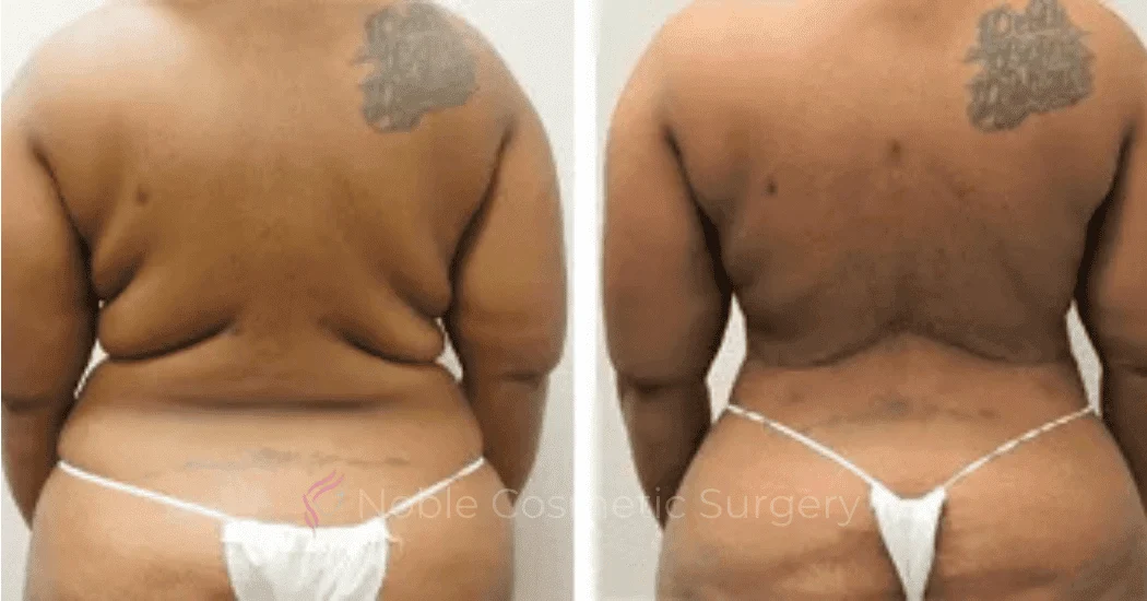 BACK-LIFT-CASE-00256 | Before and After Back Lift 1