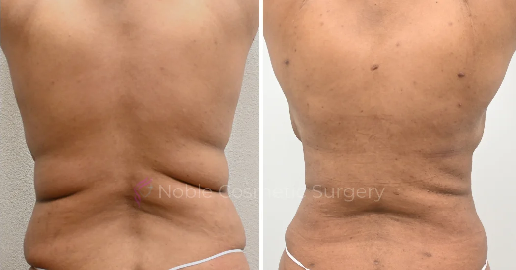 TUMMY-TUCK-CASE-00035 | Before and After Abdominoplasty 3