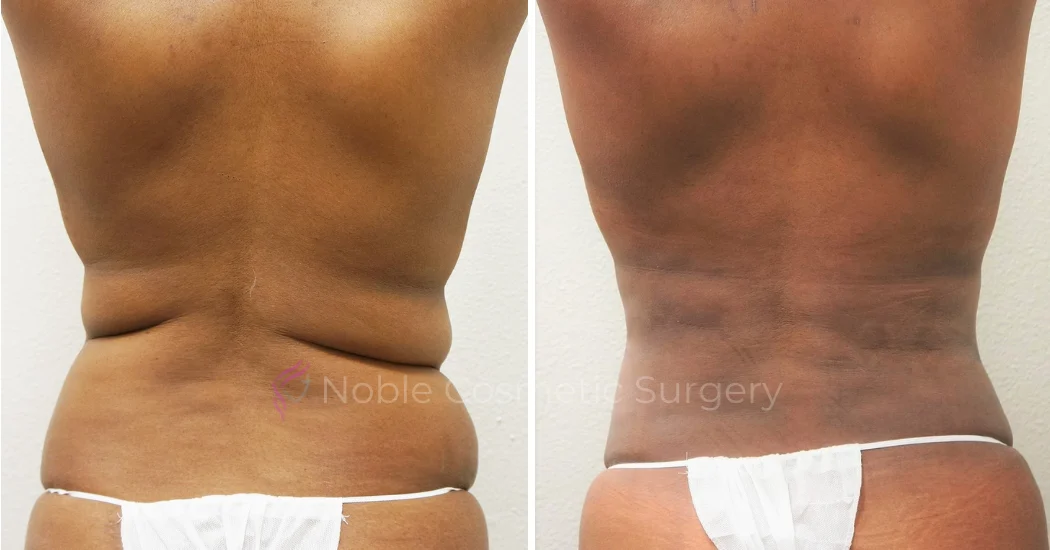 TUMMY-TUCK-CASE-00306 | Before and After Abdominoplasty 3