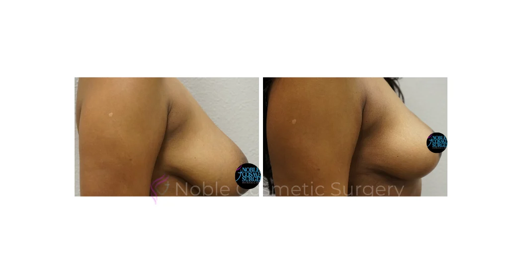 BREAST-LIFT-CASE-00675 | Before and After Breast Lift 2