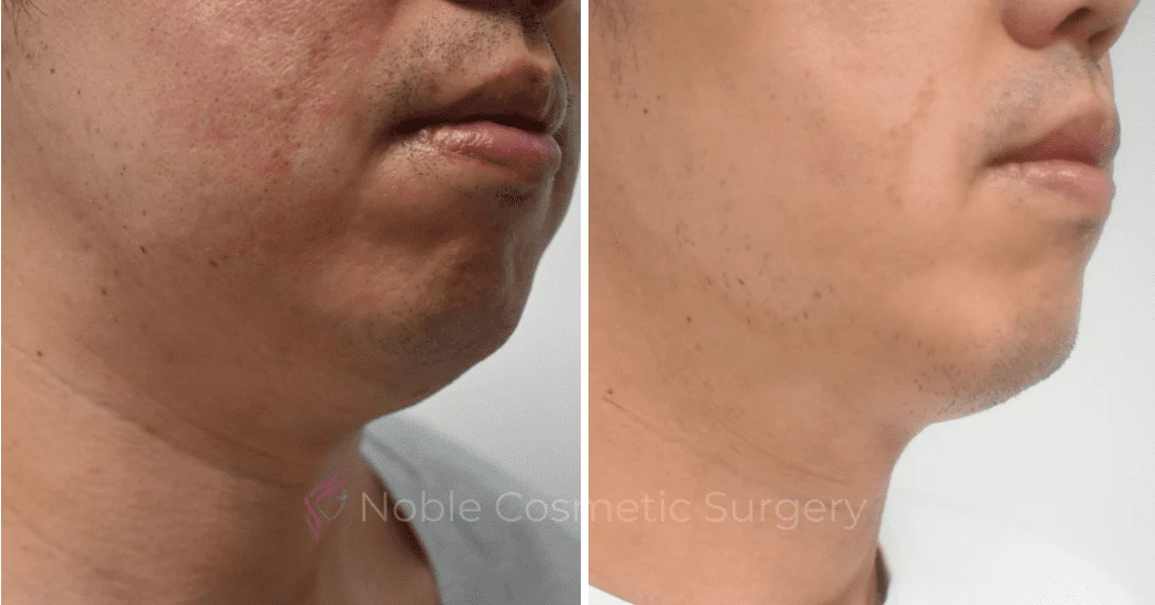 SUBMENTAL-LIPOSUCTION-CASE-10214 | Before and After Chin Liposuction 1