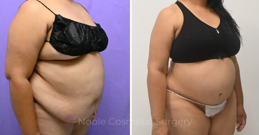 Case--10177 | Before and After Abdominoplasty 3